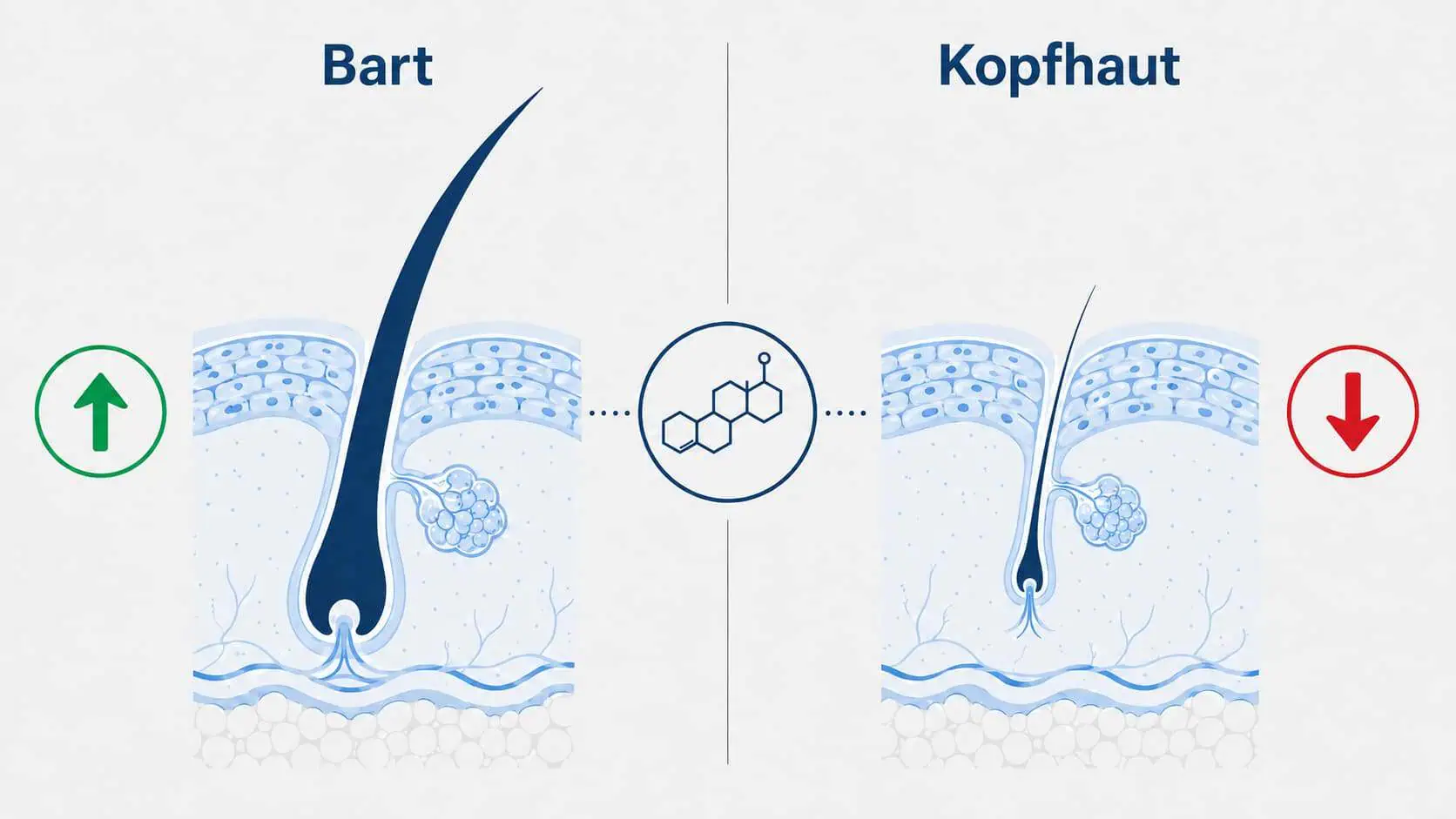 Infografik DHT-Paradox – Testosteron fördert den Bartwuchs und begünstigt Haarausfall am Kopf