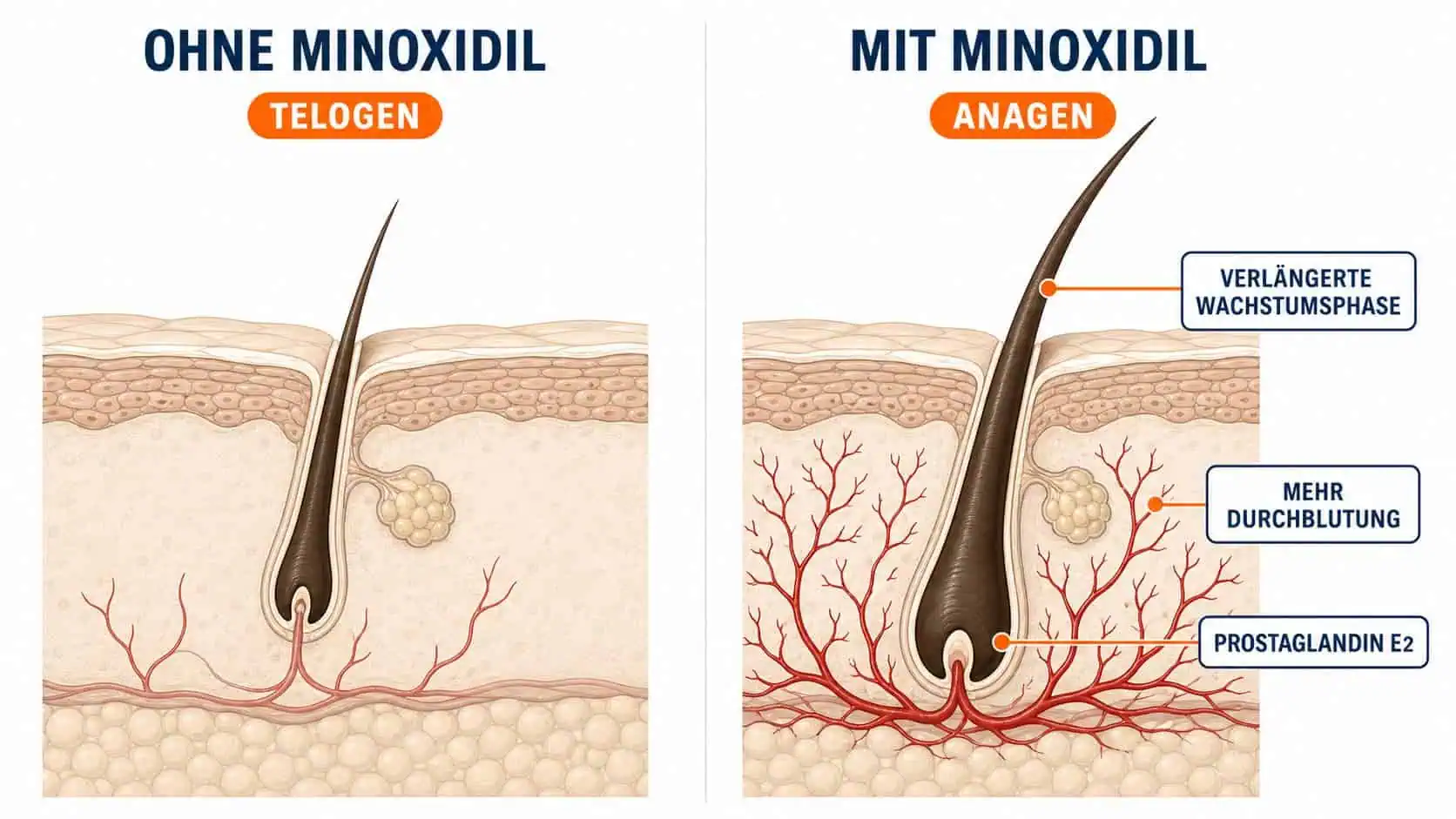 Minoxidil Wirkmechanismus – Haarfollikel mit und ohne Minoxidil im Vergleich